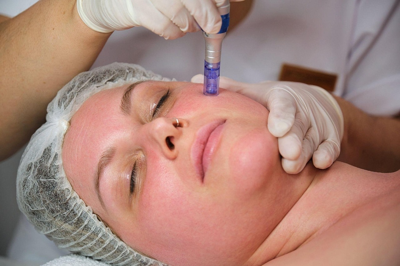 Microneedling For Acne Scars