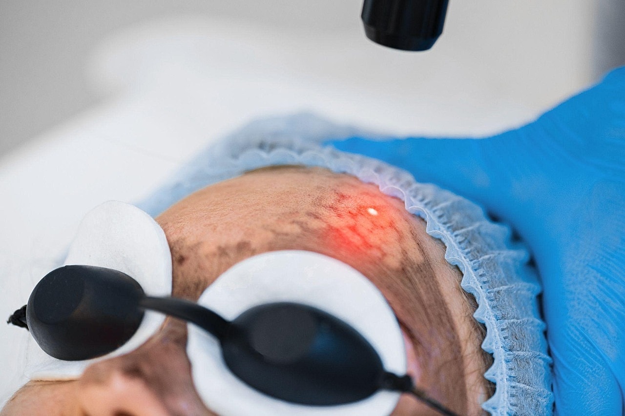 Spectra Hollywood Peel For Acne Marks And Texture