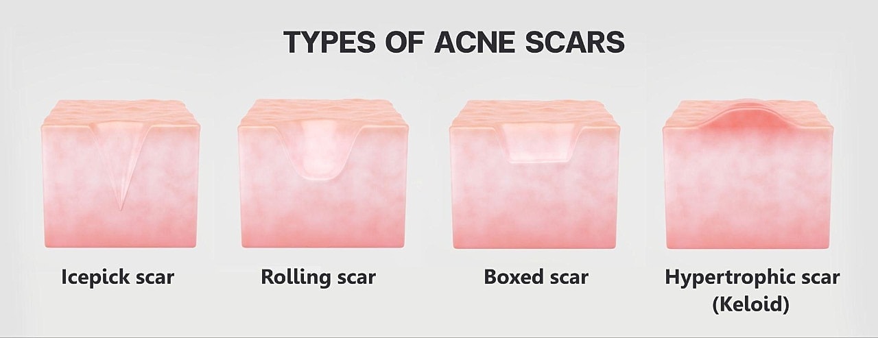 The Different Types Of Acne Scars