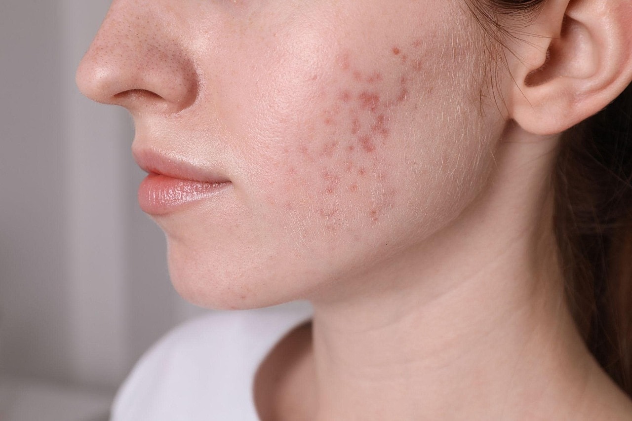 Understanding Acne Scars Why They Form