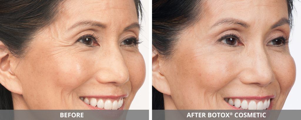 Botox Dysport Before & After