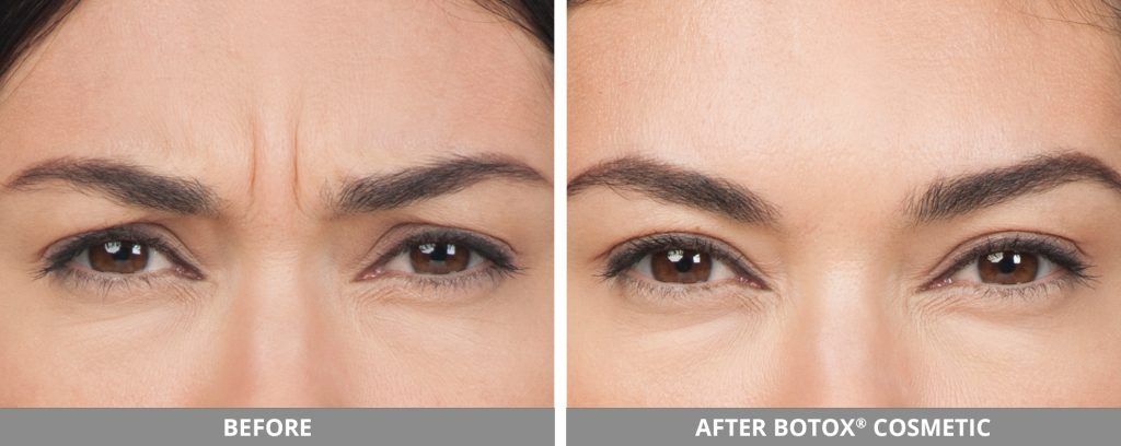Botox Dysport Before & After