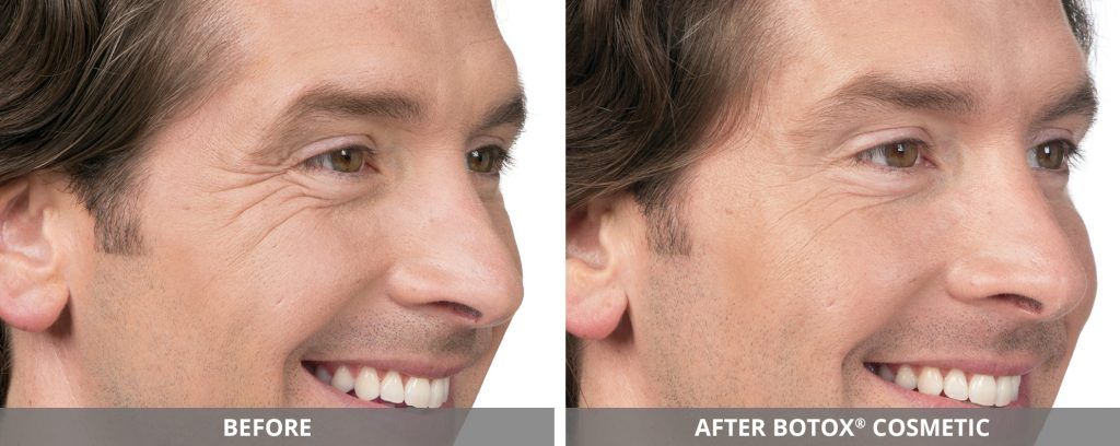 Botox Dysport Before & After