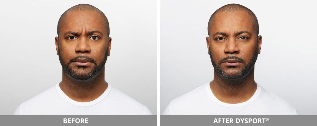 Botox Dysport Before & After