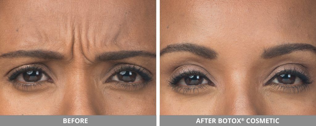 Botox Dysport Before & After