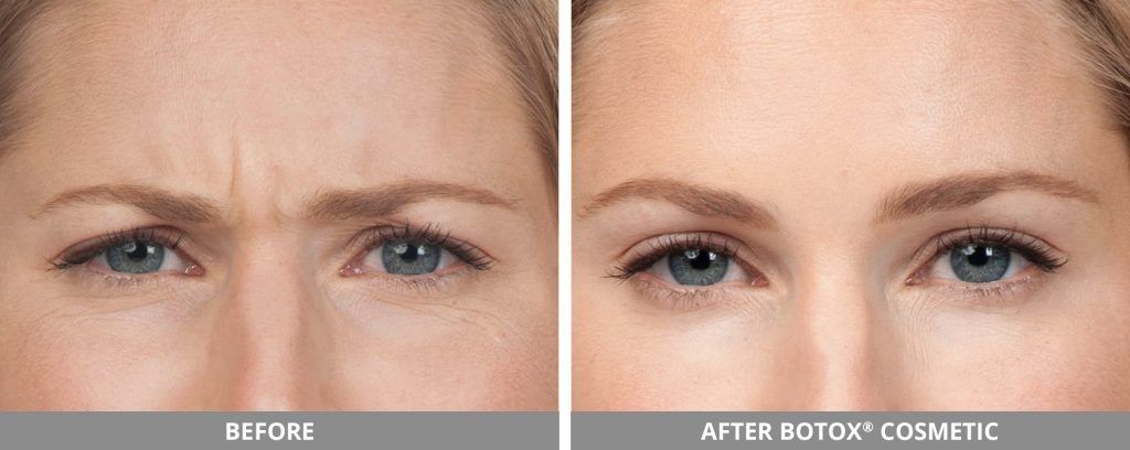Botox Dysport Before & After