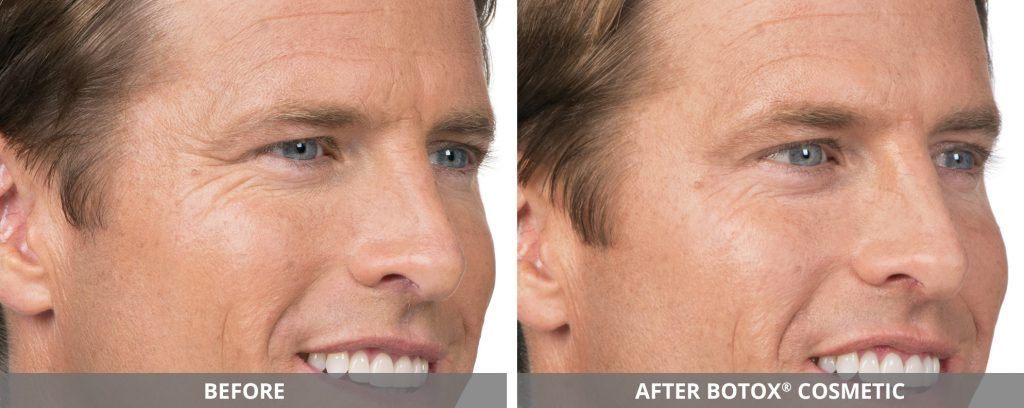 Botox Dysport Before & After