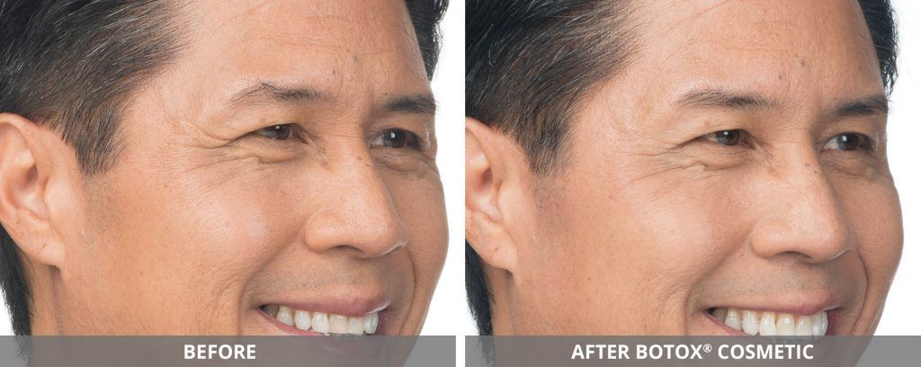 Botox Dysport Before & After