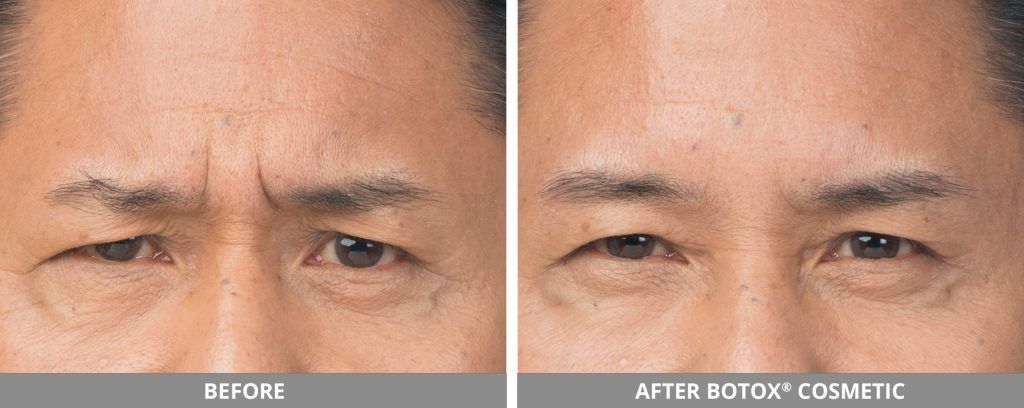 Botox Dysport Before & After
