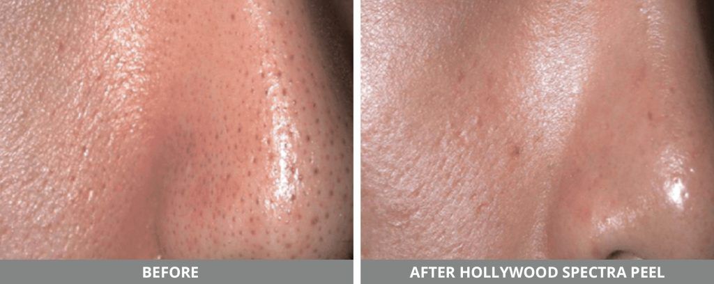 Yag Laser Before & After