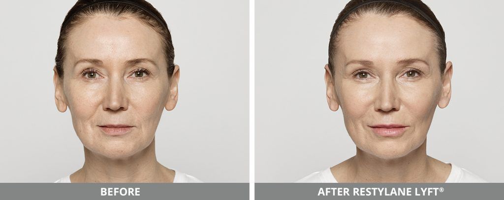 Restylane Before & After
