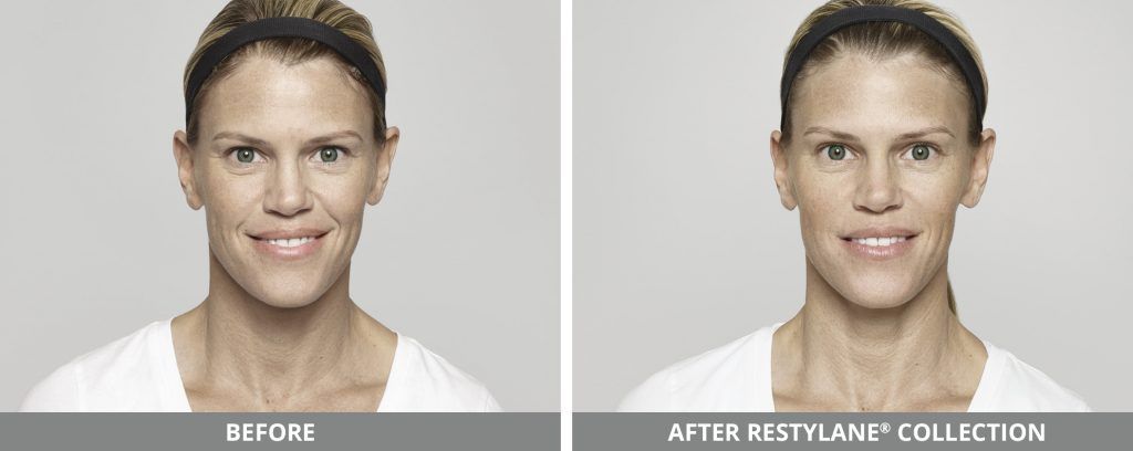 Restylane Before & After