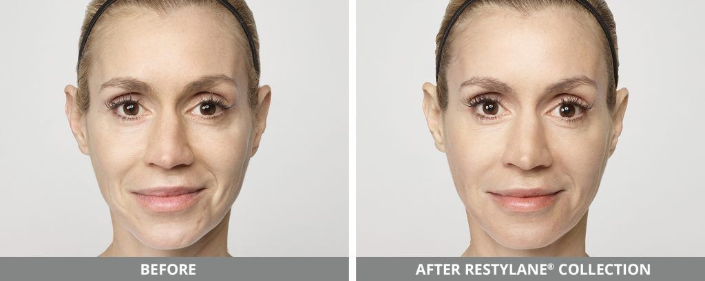 Restylane Before & After