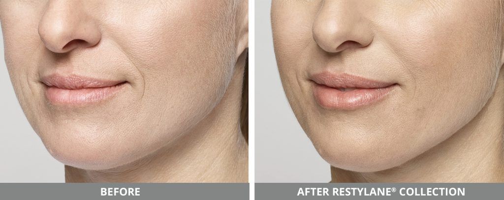 Restylane Before & After