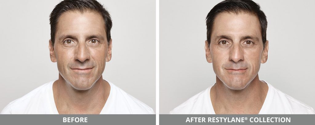 Restylane Before & After