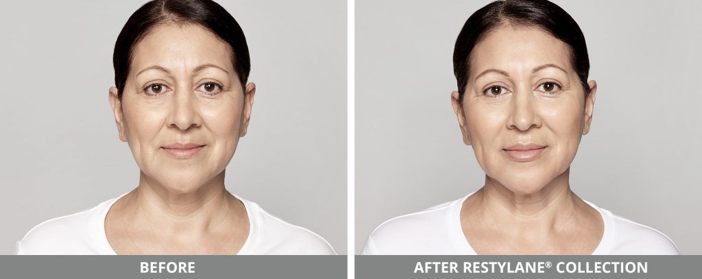 Restylane Before & After