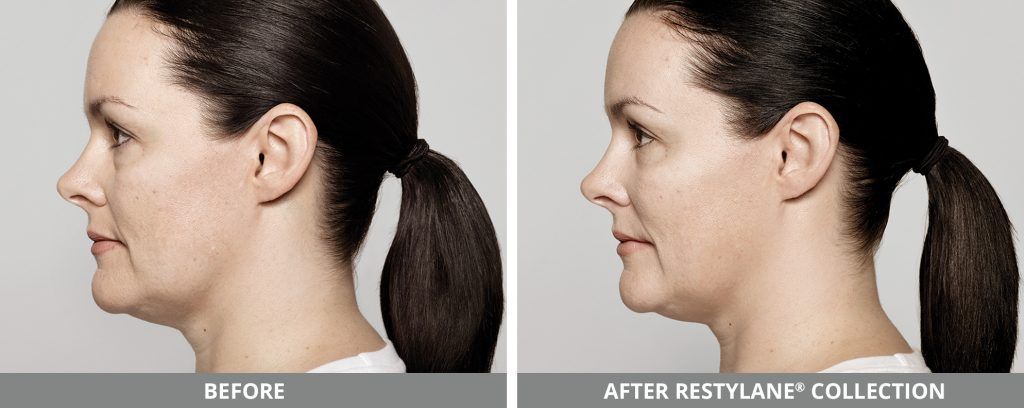 Restylane Before & After