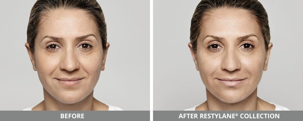 Restylane Before & After