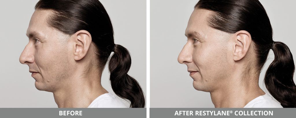 Restylane Before & After