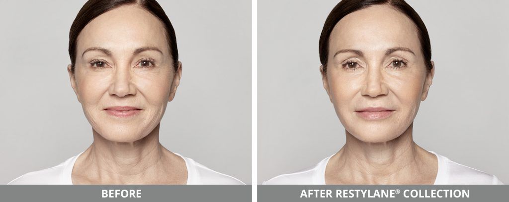 Restylane Before & After
