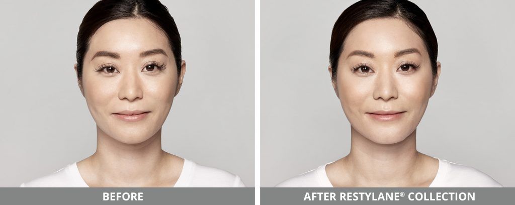 Restylane Before & After