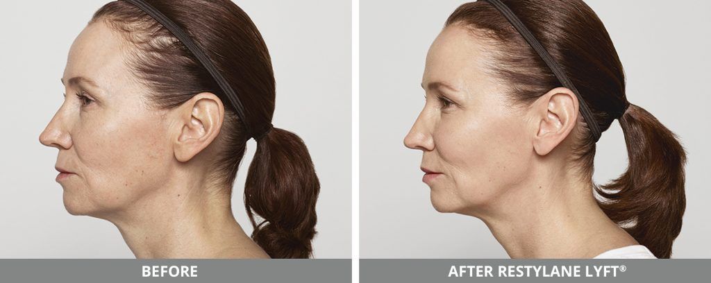 Restylane Before & After