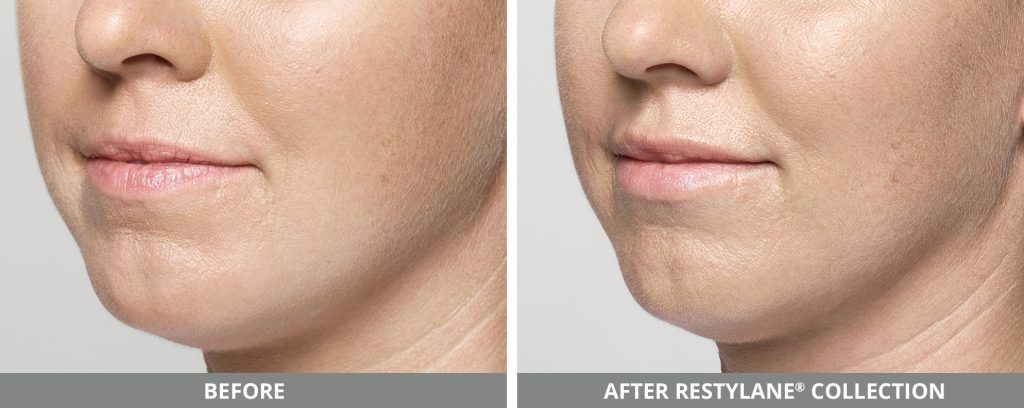 Restylane Before & After
