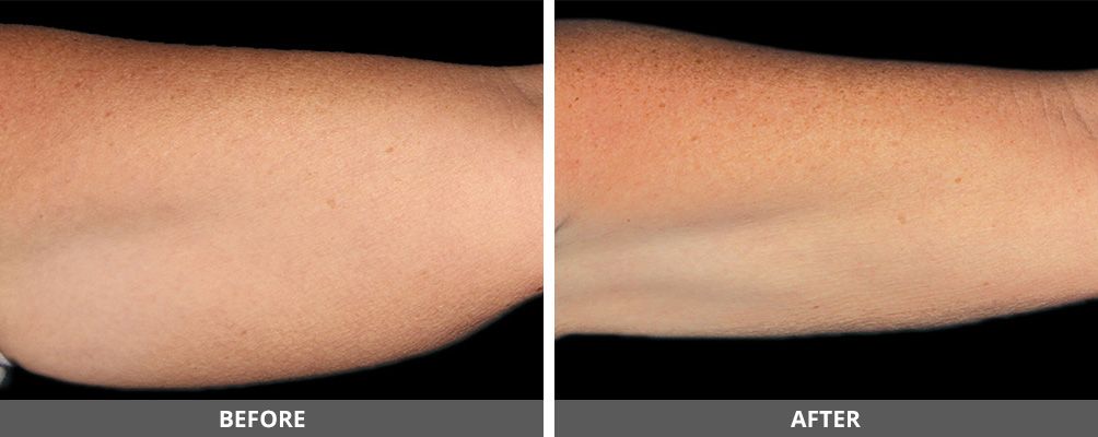 Facial And Body Contouring Before & After