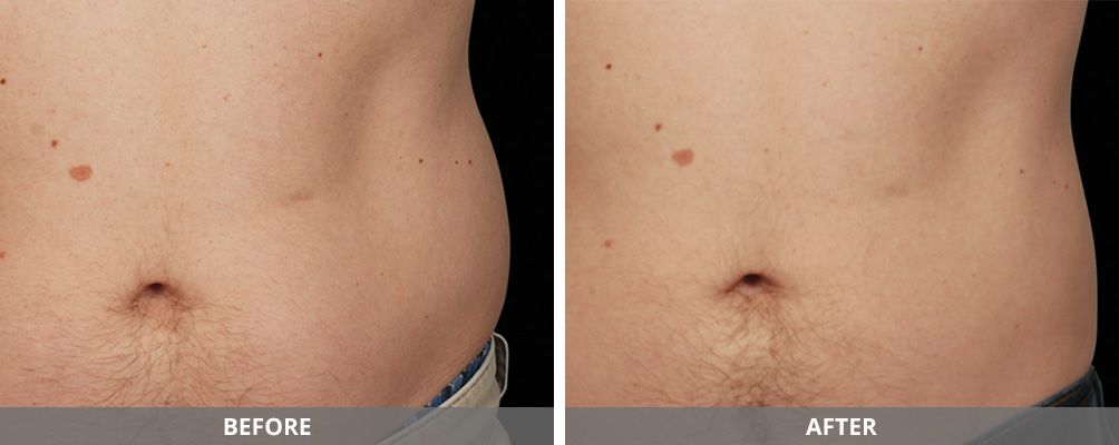 Facial And Body Contouring Before & After