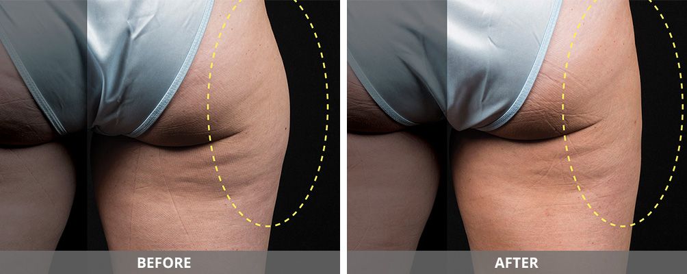 Facial And Body Contouring Before & After