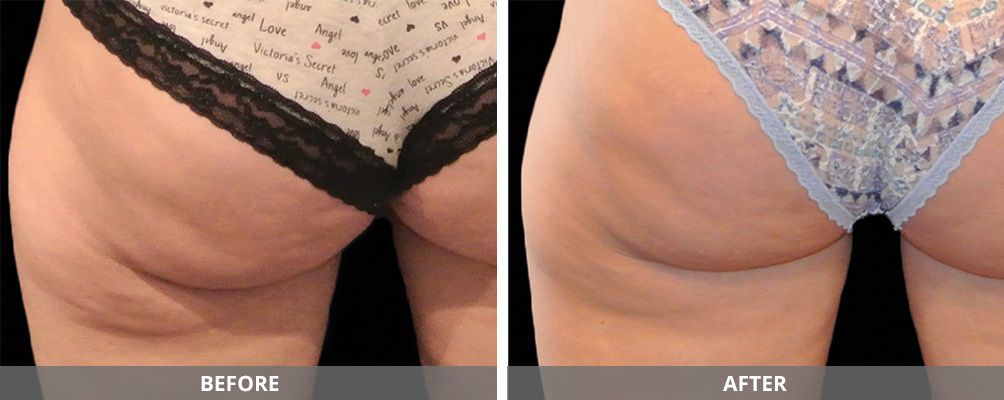 Facial And Body Contouring Before & After