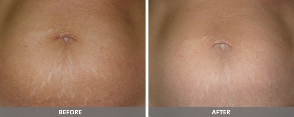 Facial And Body Contouring Before & After