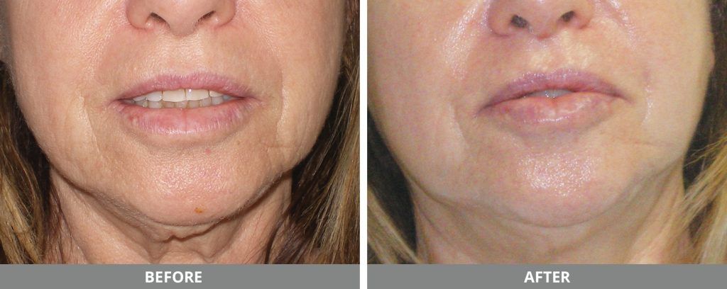 Facial And Body Contouring Before & After