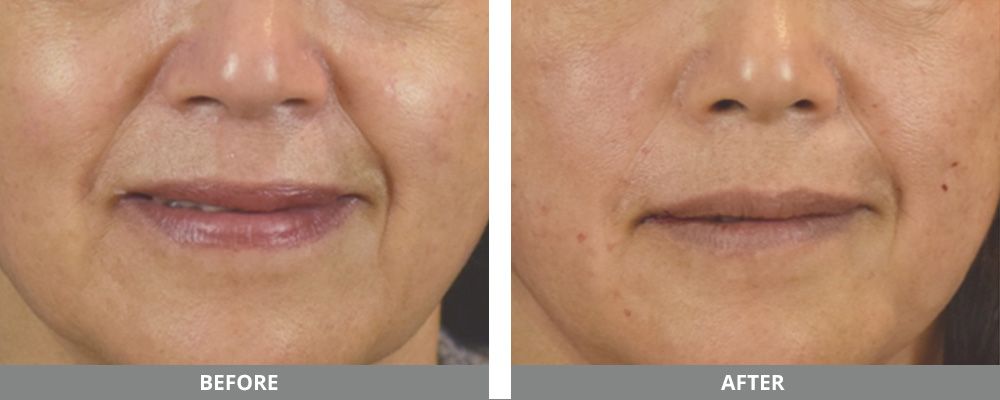 Pdo Thread Before & After