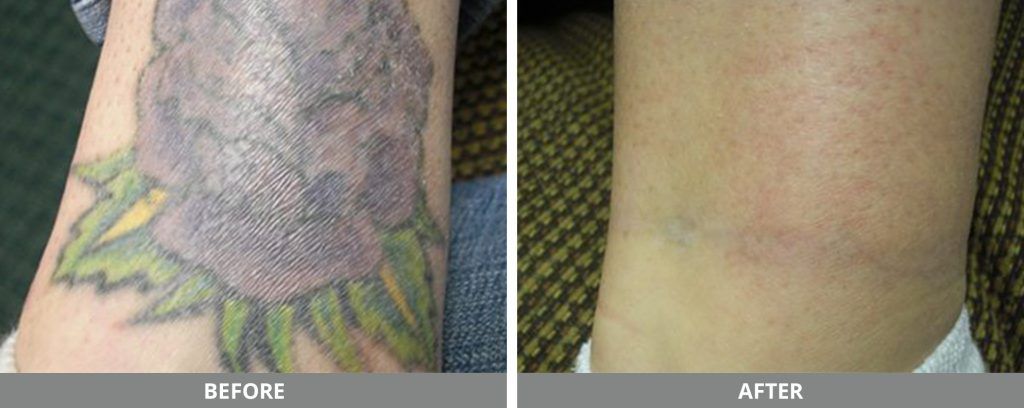 Laser Tattoo Removal Before & After