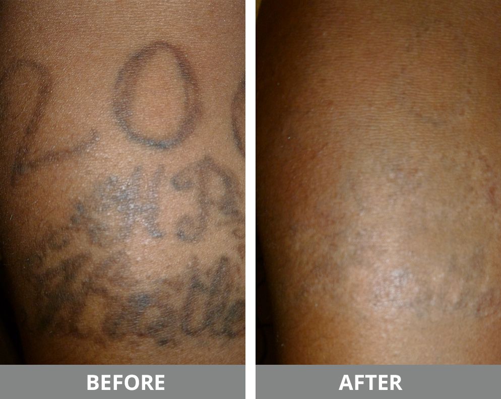 Laser Tattoo Removal Before & After