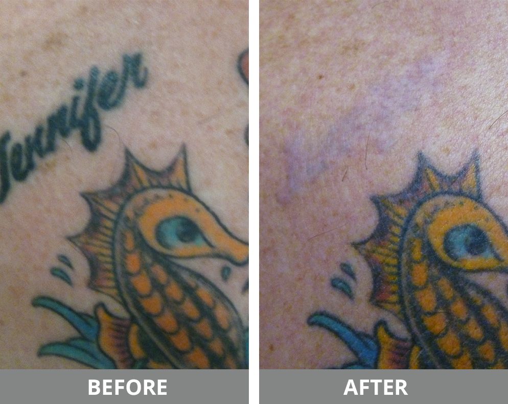 Laser Tattoo Removal Before & After