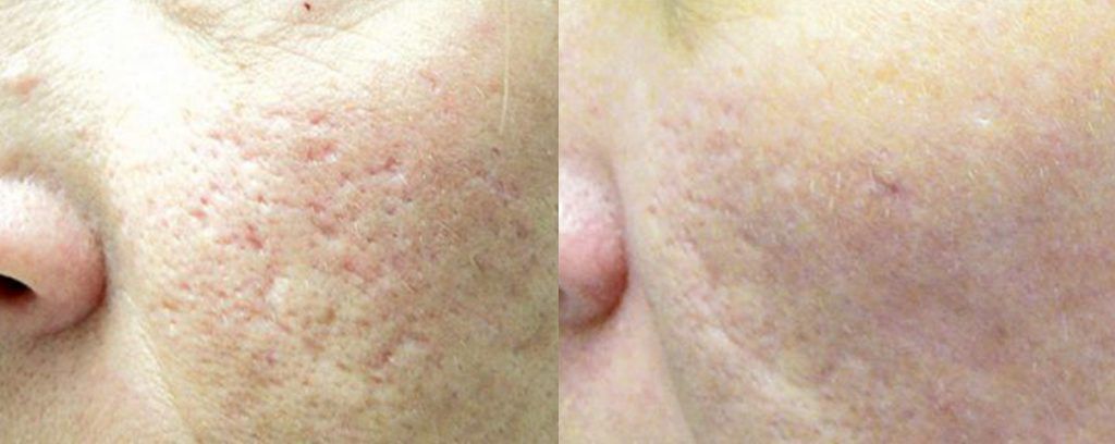 Fractional Laser Before & After