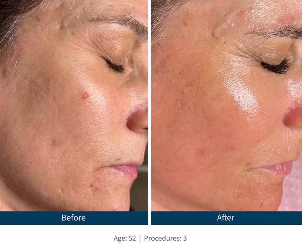 SkinPen Before & After