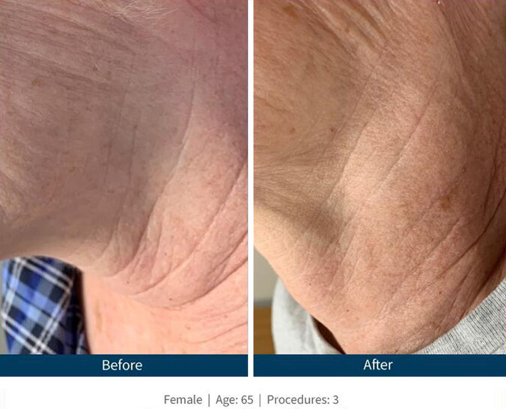 SkinPen Before & After