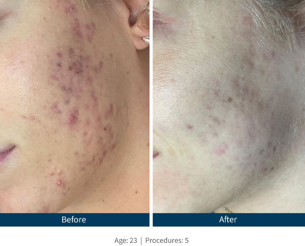 SkinPen Before & After