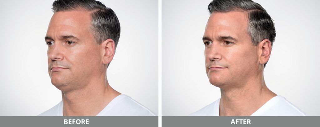 Kybella Before & After