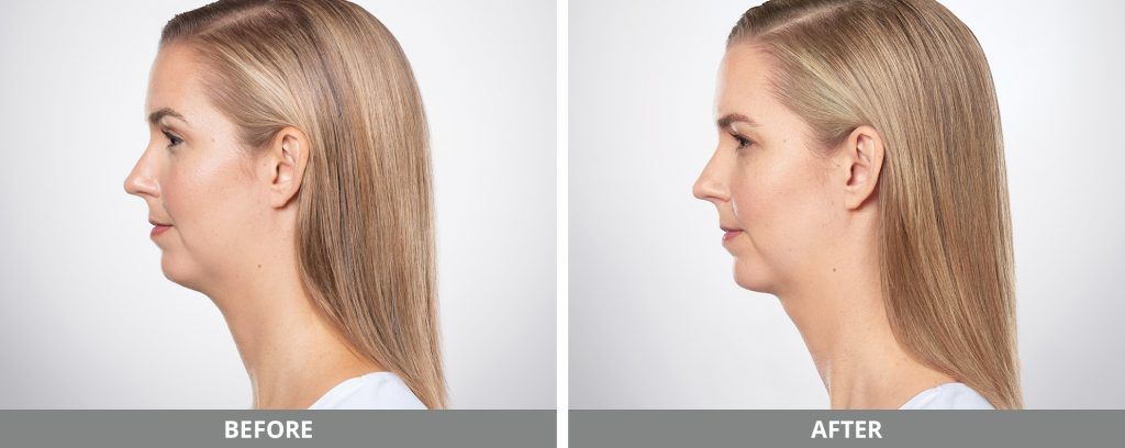 Kybella Before & After