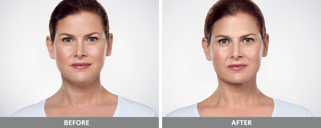 Kybella Before & After