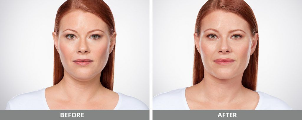 Kybella Before & After