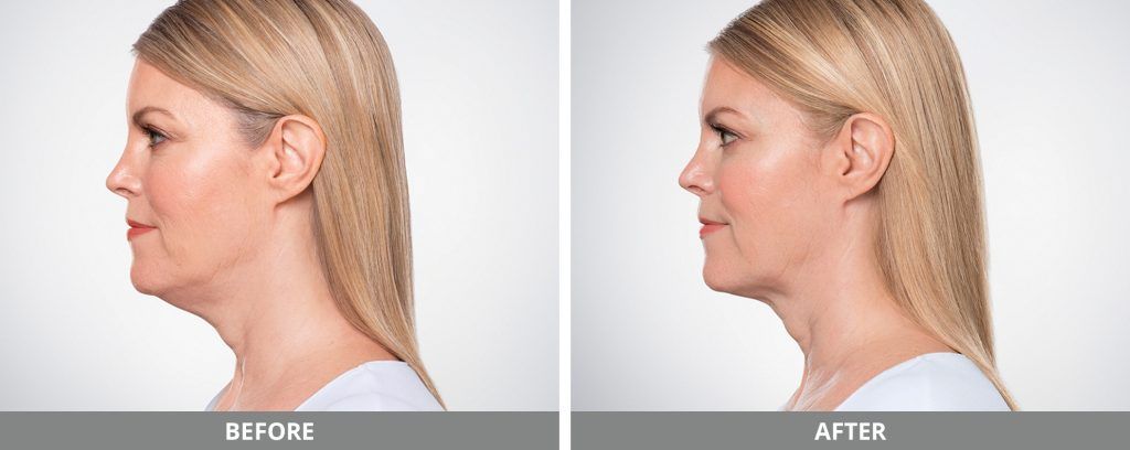 Kybella Before & After