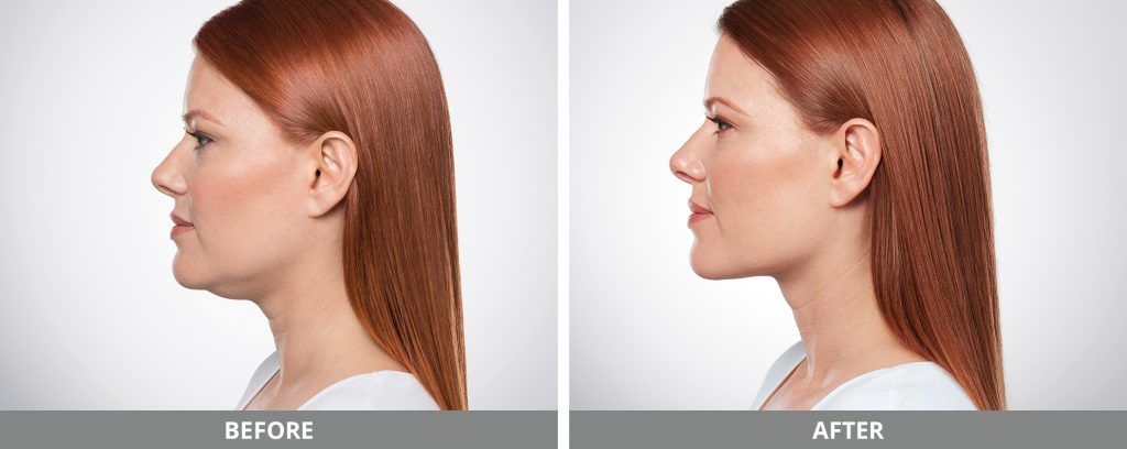 Kybella Before & After