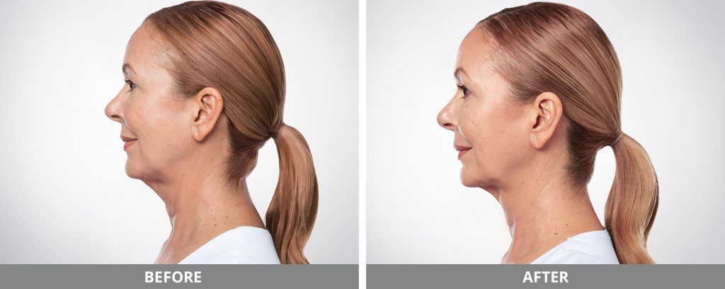 Kybella Before & After