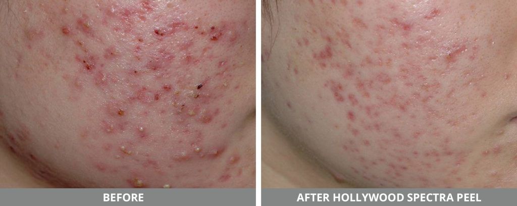 Hollywood Laser Spectra Before & After