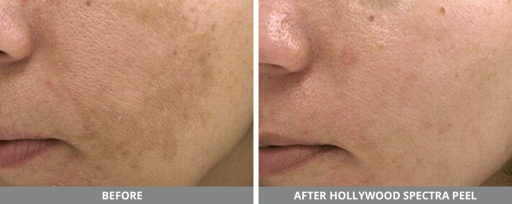 Hollywood Laser Spectra Before & After